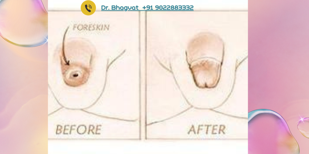 Open Circumcision in Mumbra/Thane