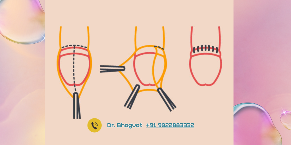 Stapler Circumcision in Mumbra/Thane
